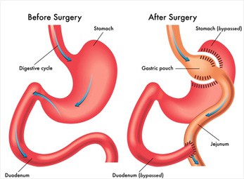 Weight Loss Gastric Bypass Surgery
