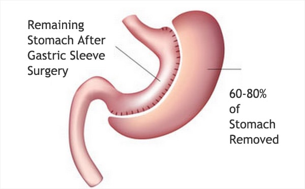 Gastric Sleeve Surgery After