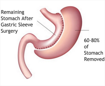 Weight Loss Gastric Sleeve Surgery