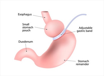 Weight Loss Lap Banding Surgery