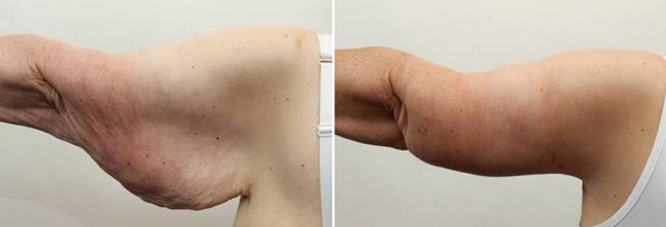 Upper Arm Surgery (Brachioplasty): Before and After