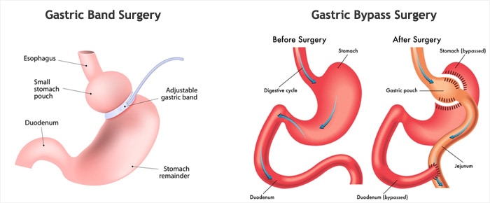 Gastric Sleeve Surgery comparison to other surgery